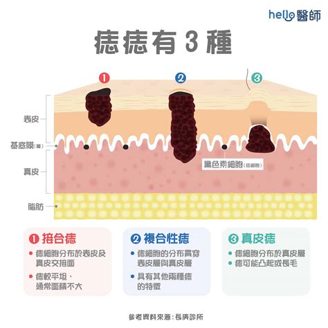 身上黑痣增多|為什麼臉上的痣越來越多？皮膚科醫師解析長痣原因、。